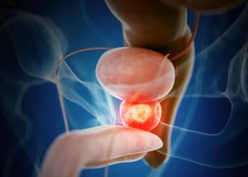 El cáncer de próstata es el tumor más frecuente entre los hombres