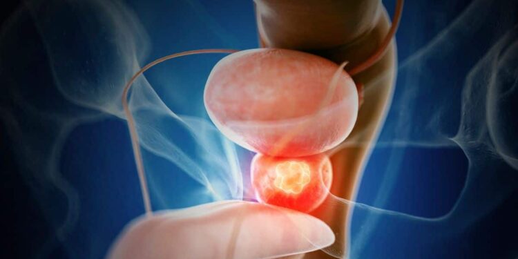 El cáncer de próstata es el tumor más frecuente entre los hombres