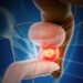 El cáncer de próstata es el tumor más frecuente entre los hombres