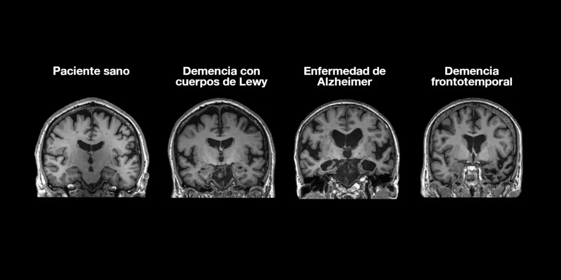 «El Alzheimer es la gran pandemia del siglo XXI»: Tomás Sobrino se une a Alzheimer Care para impulsar la investigación en Galicia