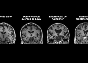 «El Alzheimer es la gran pandemia del siglo XXI»: Tomás Sobrino se une a Alzheimer Care para impulsar la investigación en Galicia