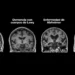 «El Alzheimer es la gran pandemia del siglo XXI»: Tomás Sobrino se une a Alzheimer Care para impulsar la investigación en Galicia